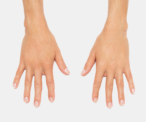 Photo of actual patient's hand with Radiesse treatment. Individual results may vary.