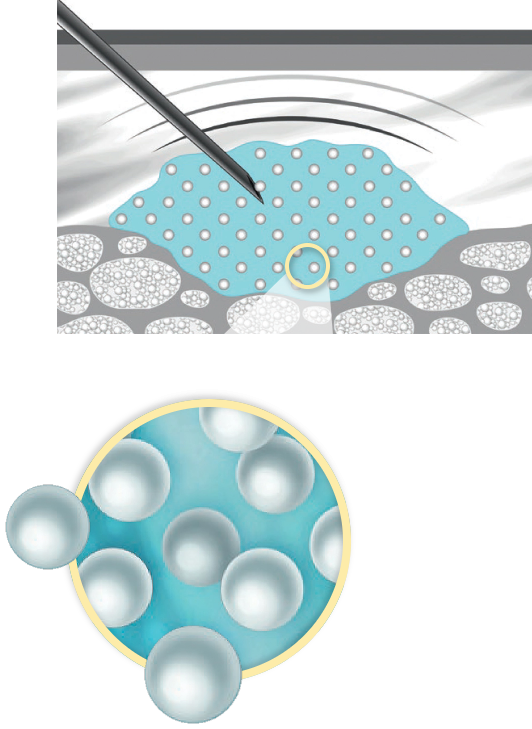 graphic of how Calcium hydroxylapatite works once injected into the skin