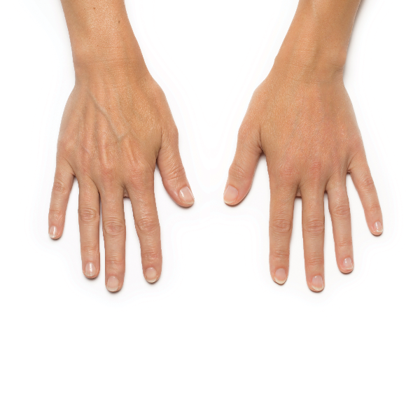 Before and after comparison of Radiesse treatment for hands.