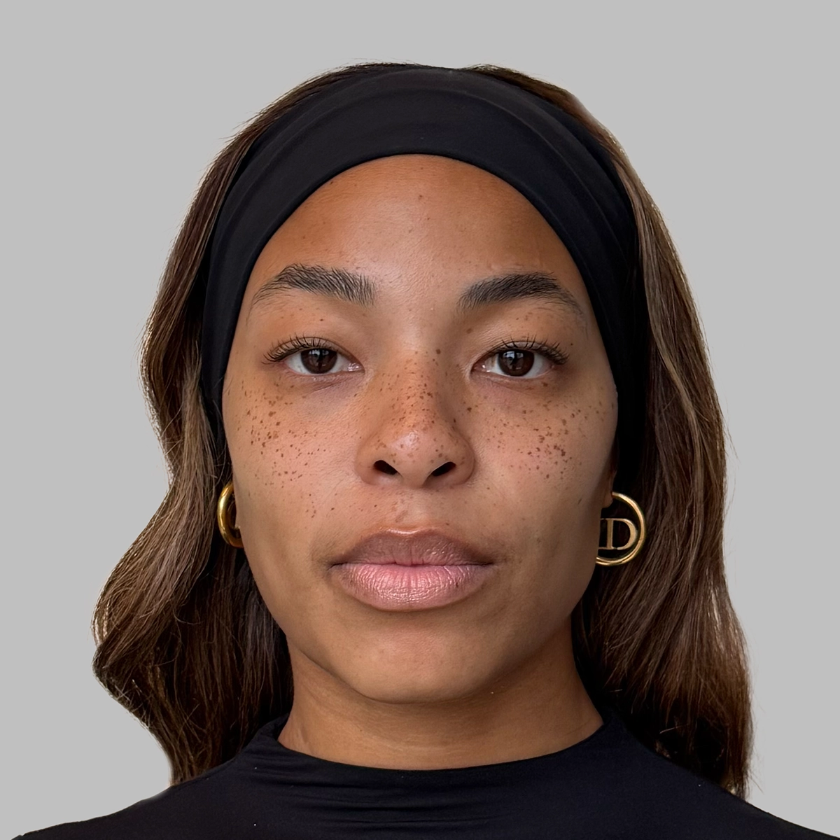 Real photo of Kam, a Radiesse patient