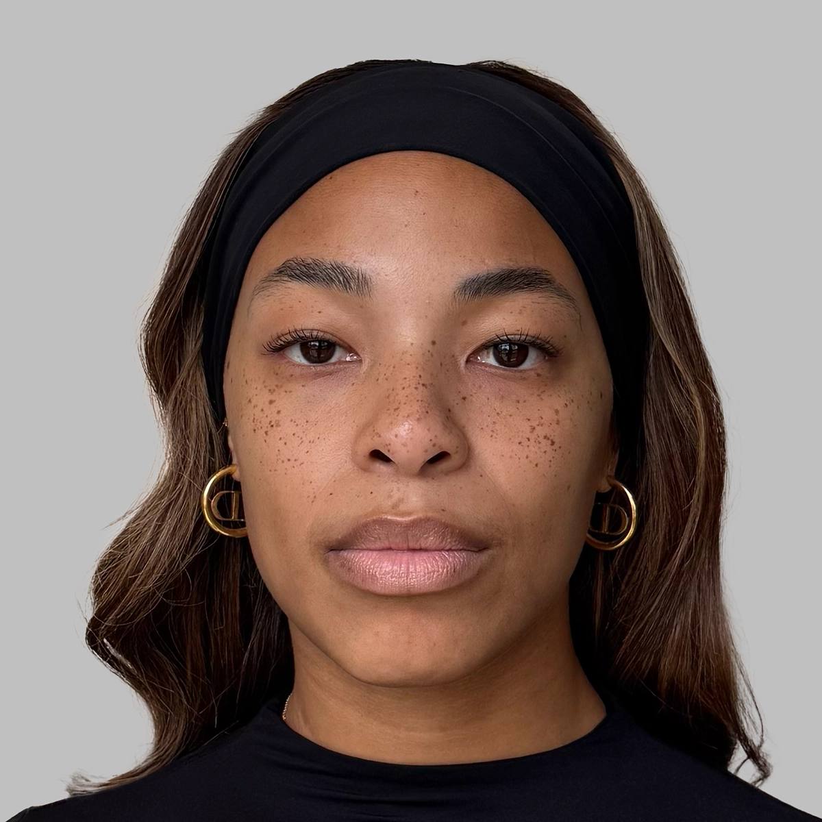 Real photo of Kam, a Radiesse patient