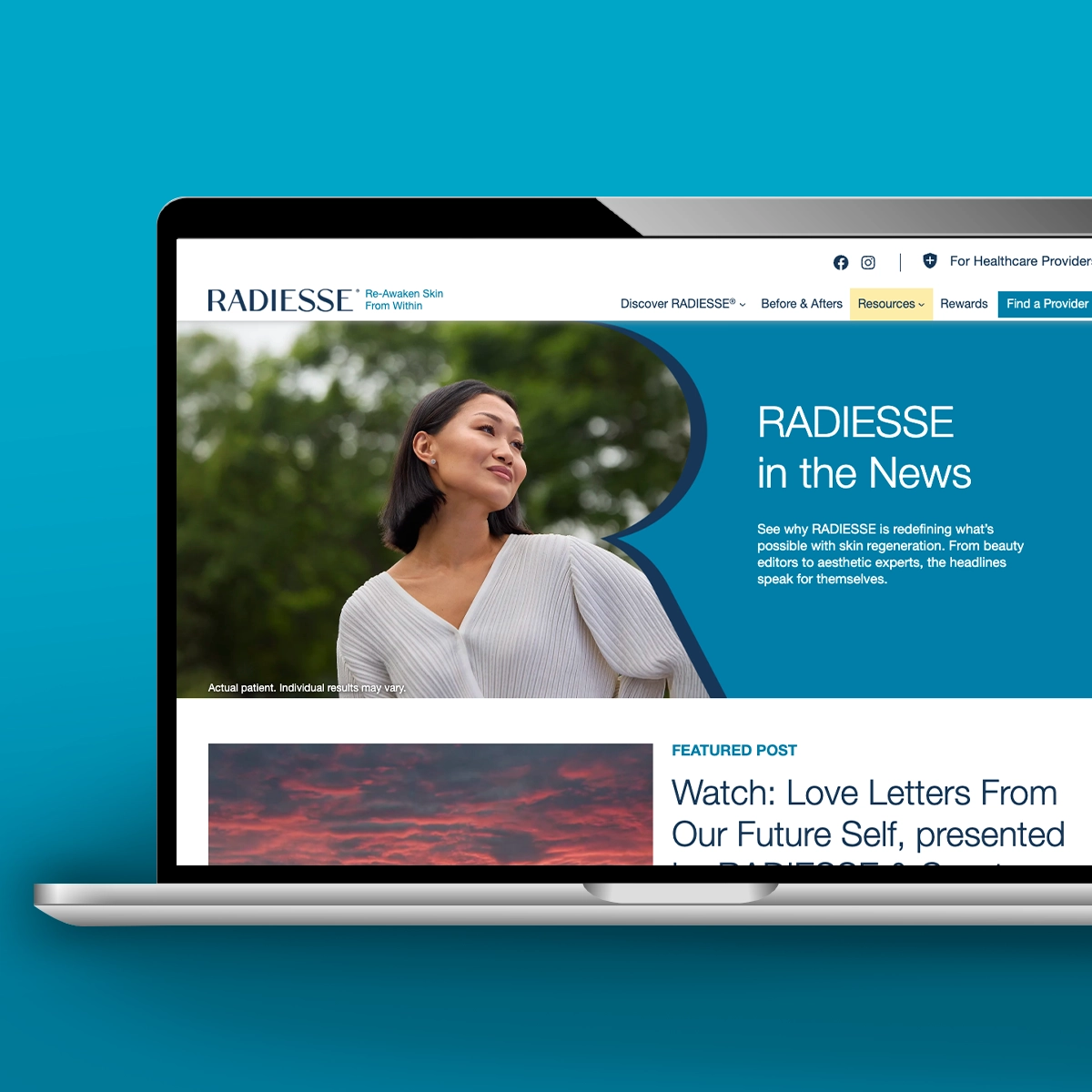 Computer screen showing Radiesse in the News webpage